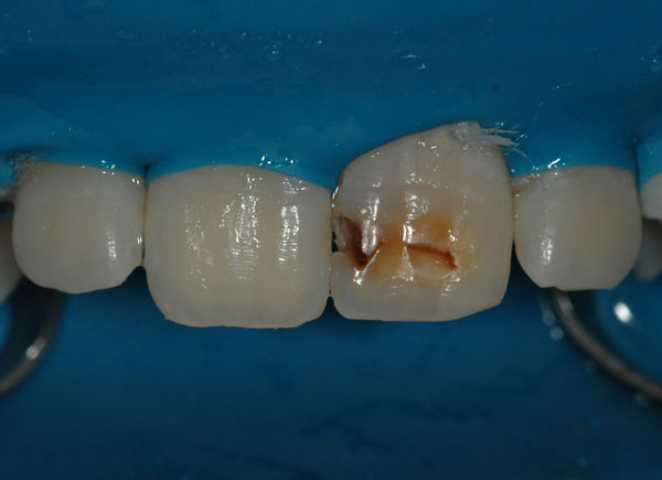 Ząb w trakcie leczenia