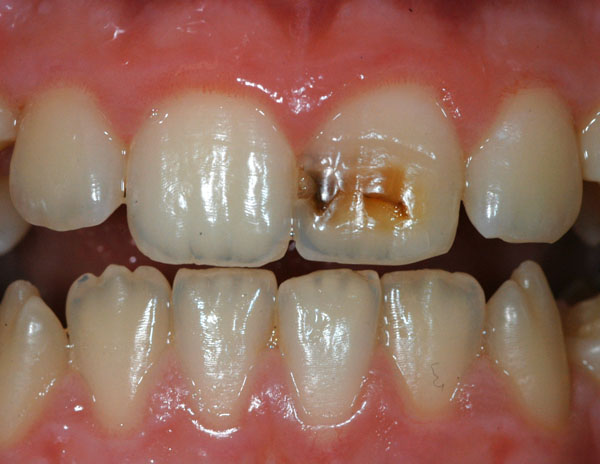Ząb  z  próchnic